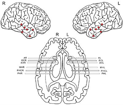 Seizure Onset Zone Lateralization Using a Non-linear Analysis of Micro vs. Macro Electroencephalographic Recordings During Seizure-Free Stages of the Sleep-Wake Cycle From Epilepsy Patients